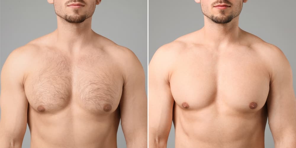 Before and after image of male chest waxing showing smooth, hair-free skin.
