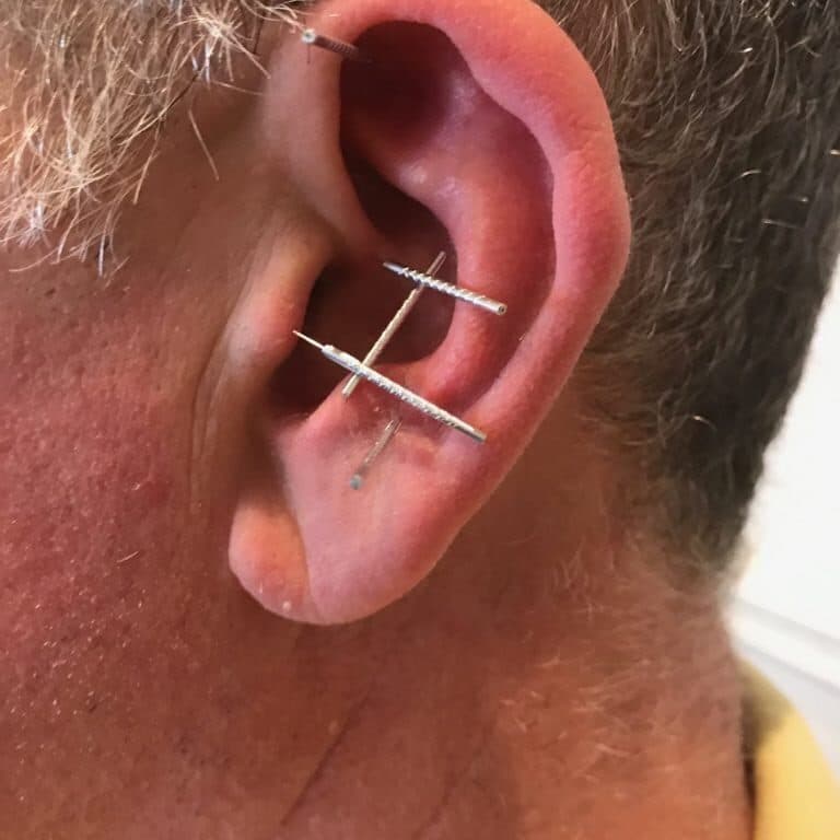 Close-up of a man’s ear with acupuncture needles during a one-to-one ear acupuncture session in Weston-super-Mare